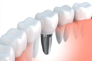 Dental Implants Dentist Fairway KS