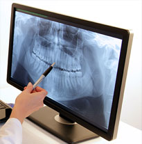 Low Radiation Dental X-rays Fairway KS