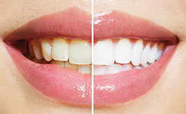 Teeth Whitening Dentist Fairway KS